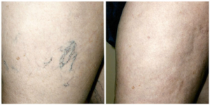 Varicose Vein Before and After Cleveland, Beachwood, Lake County, Westlake