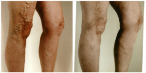 Varicose Vein Before and After Cleveland, Beachwood, Lake County, Westlake