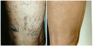 Varicose Vein Before and After Cleveland, Beachwood, Lake County, Westlake