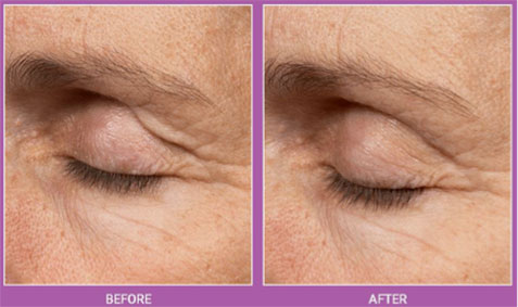 Thermage Before and After