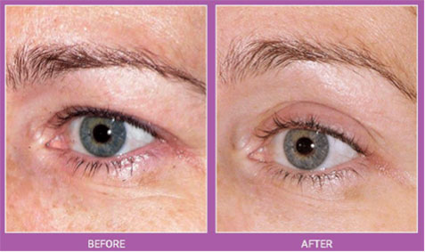 Thermage Before and After