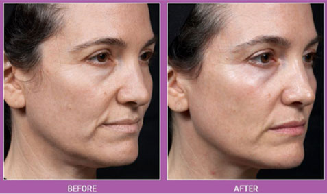 Thermage Before and After