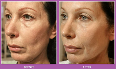 Thermage Before and After
