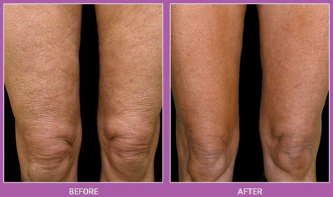 Thermage Before and After