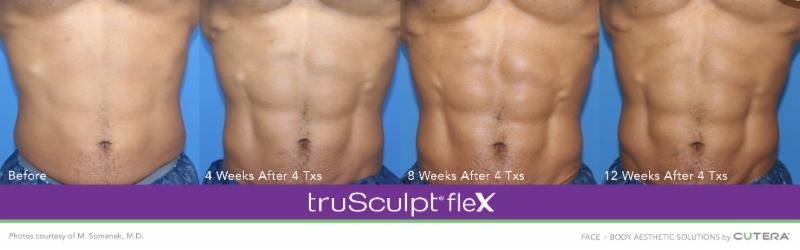 truSculpt® ﬂex Before and After Photos