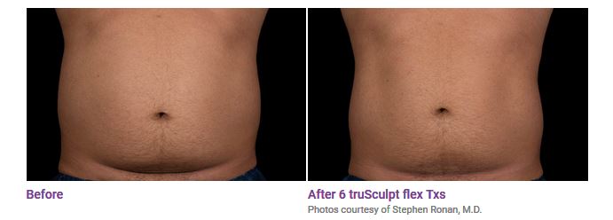 truSculpt® ﬂex Before and After Photos