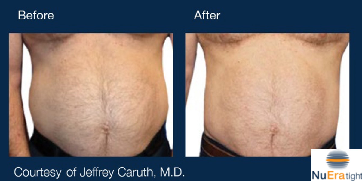 NuEra Tight Before and After