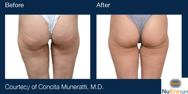 NuEra Tight Before and After