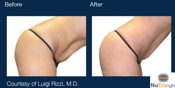 NuEra Tight Before and After