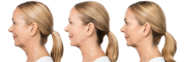 kybella