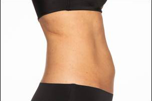 CoolSculpting Elite Before and After photos