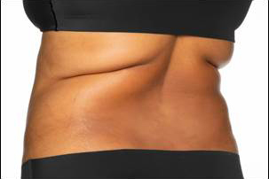 CoolSculpting Elite Before and After photos