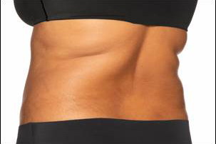 CoolSculpting Elite Before and After photos