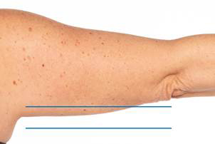 CoolSculpting Elite Before and After photos