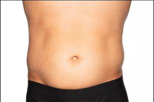 CoolSculpting Elite Before and After photos