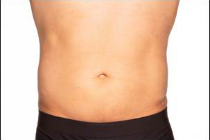 CoolSculpting Elite Before and After photos