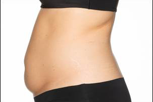 CoolSculpting Elite Before and After photos