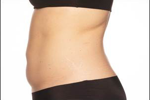 CoolSculpting Elite Before and After photos