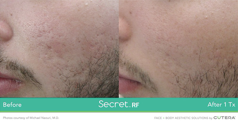 Secret RF before and after