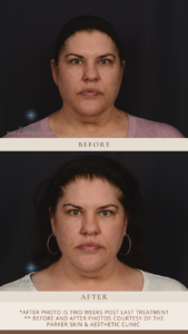 Skintrinsiq™ Before & After