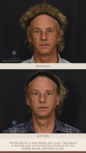 Skintrinsiq™ Before & After