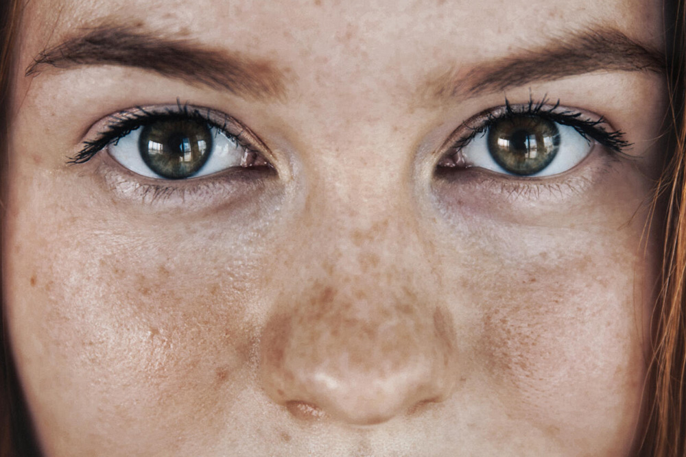 Laser Treatment of Pigmented Spots Services Derm of Cape Cod