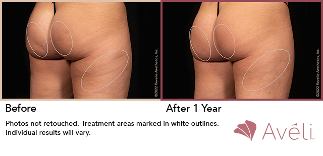 Aveli Before and After