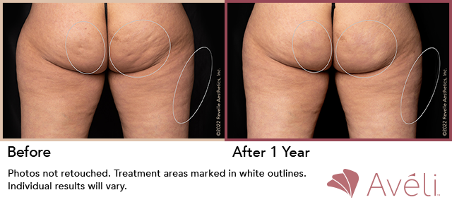 Aveli Before and After