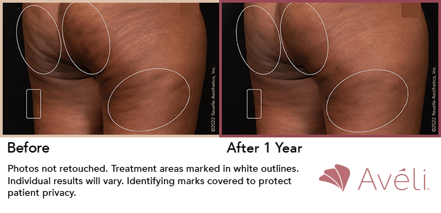 Aveli Before and After