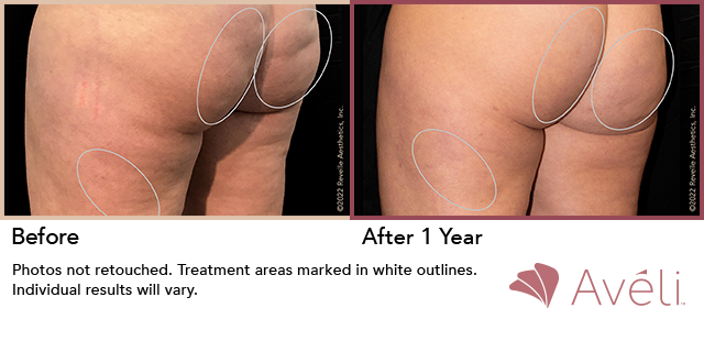 Aveli Before and After