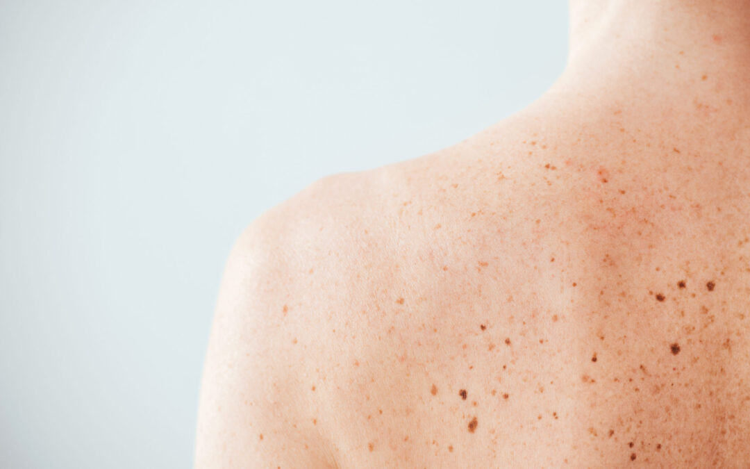 The ABCDEs of Melanoma: Early Detection Guide