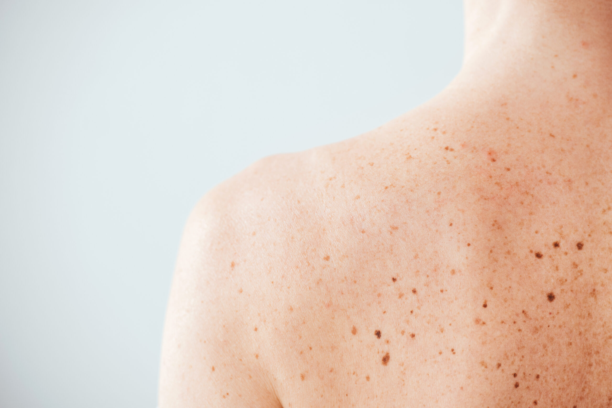 The ABCDEs of Melanoma: Early Detection Guide