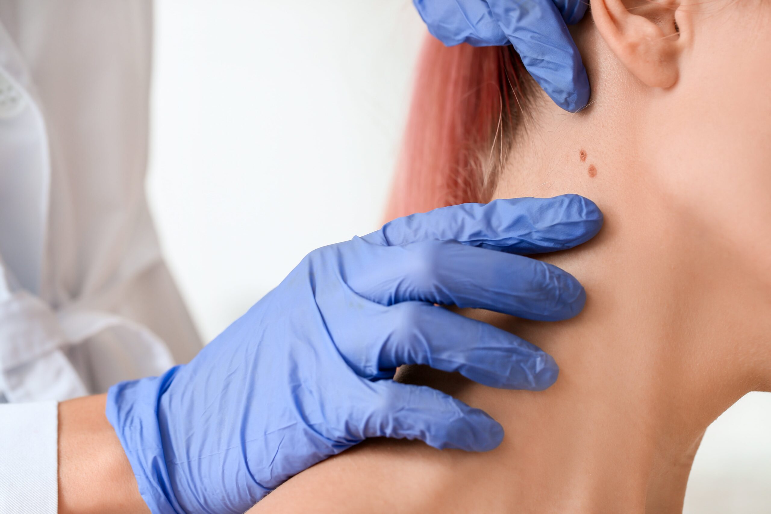 A dermatologist wearing blue gloves examines moles on a patient's neck.