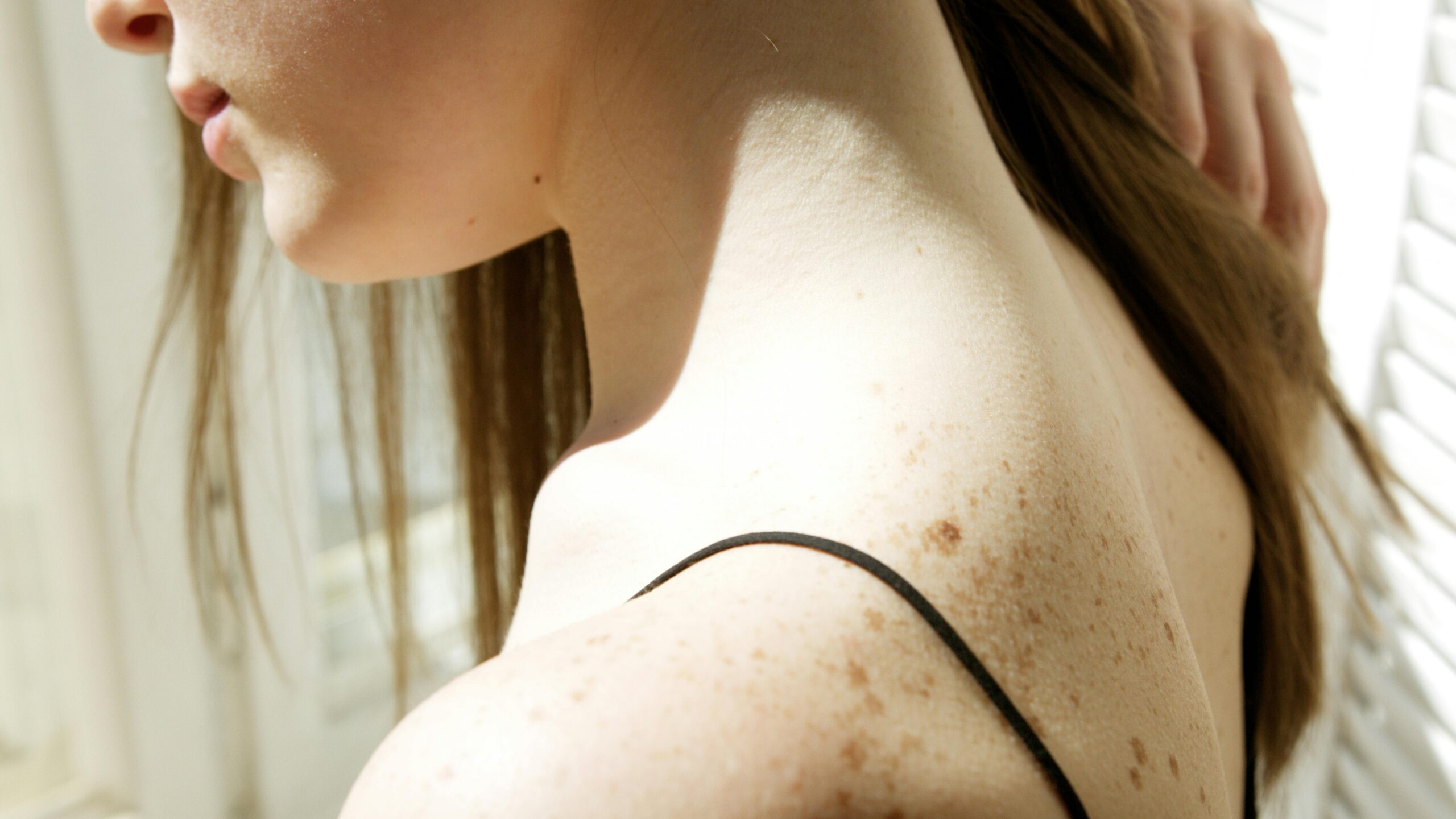 Tinea Versicolor