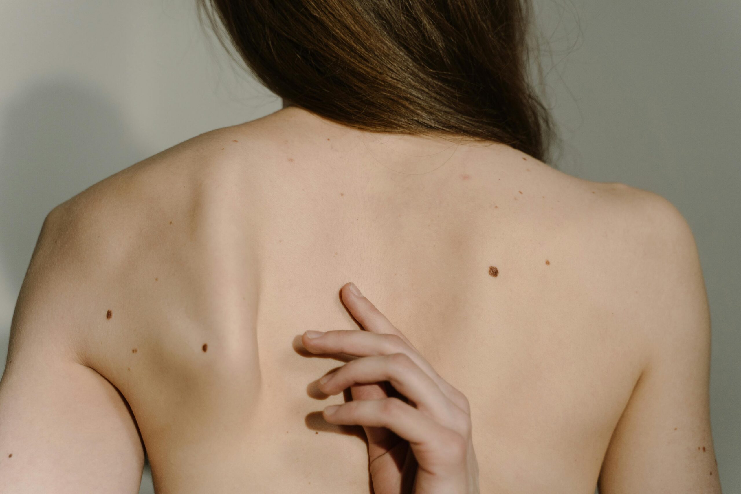 Warts