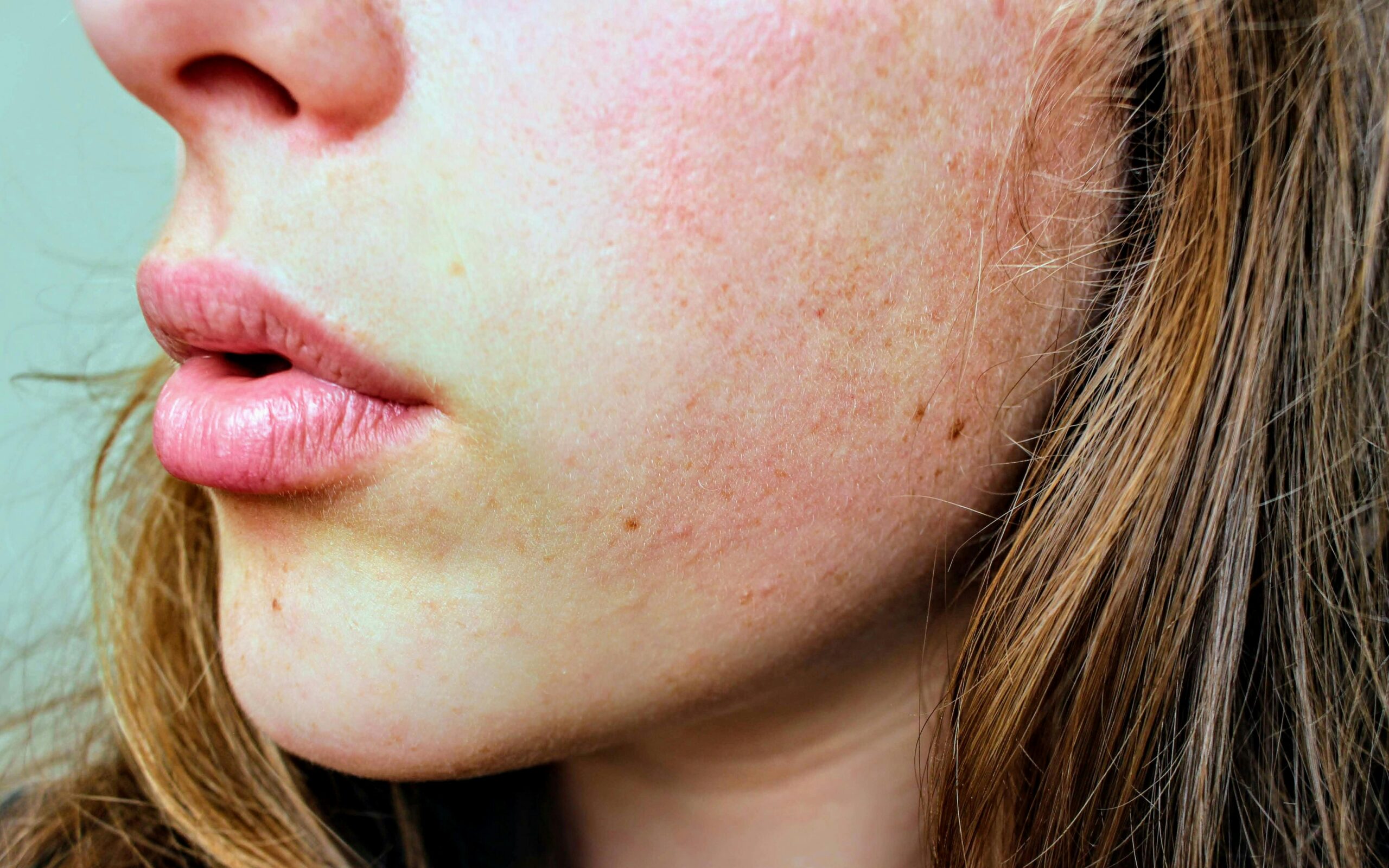 Seborrheic Keratosis