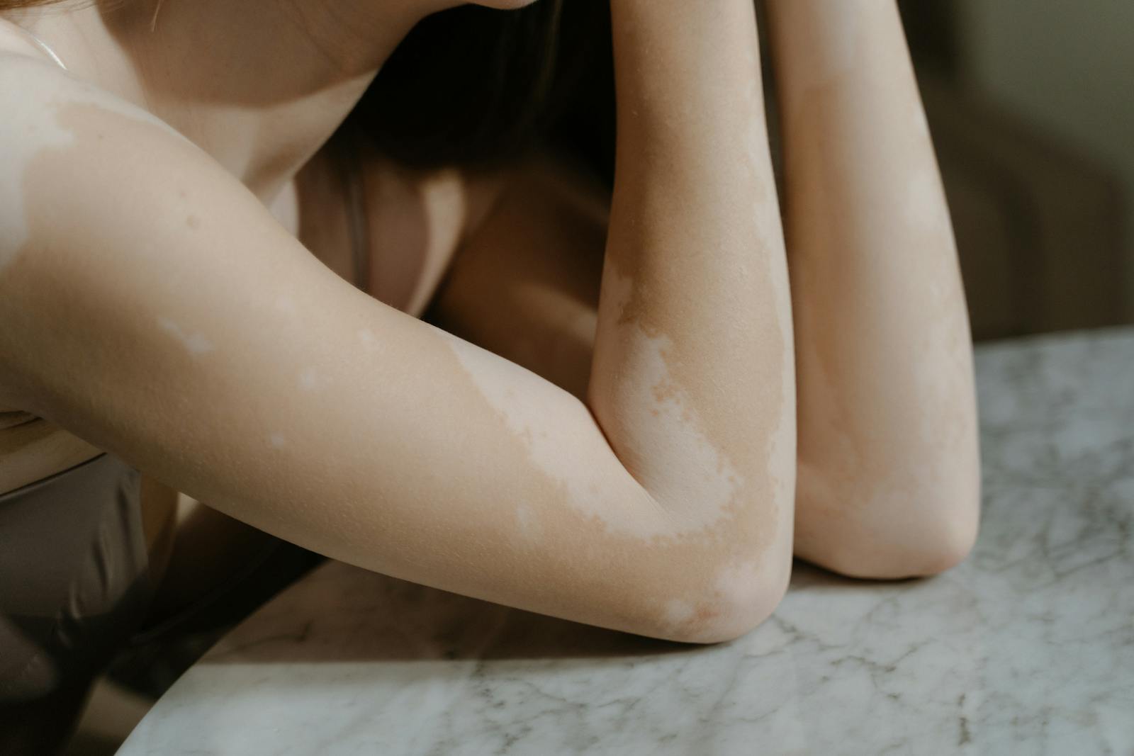 Vitiligo